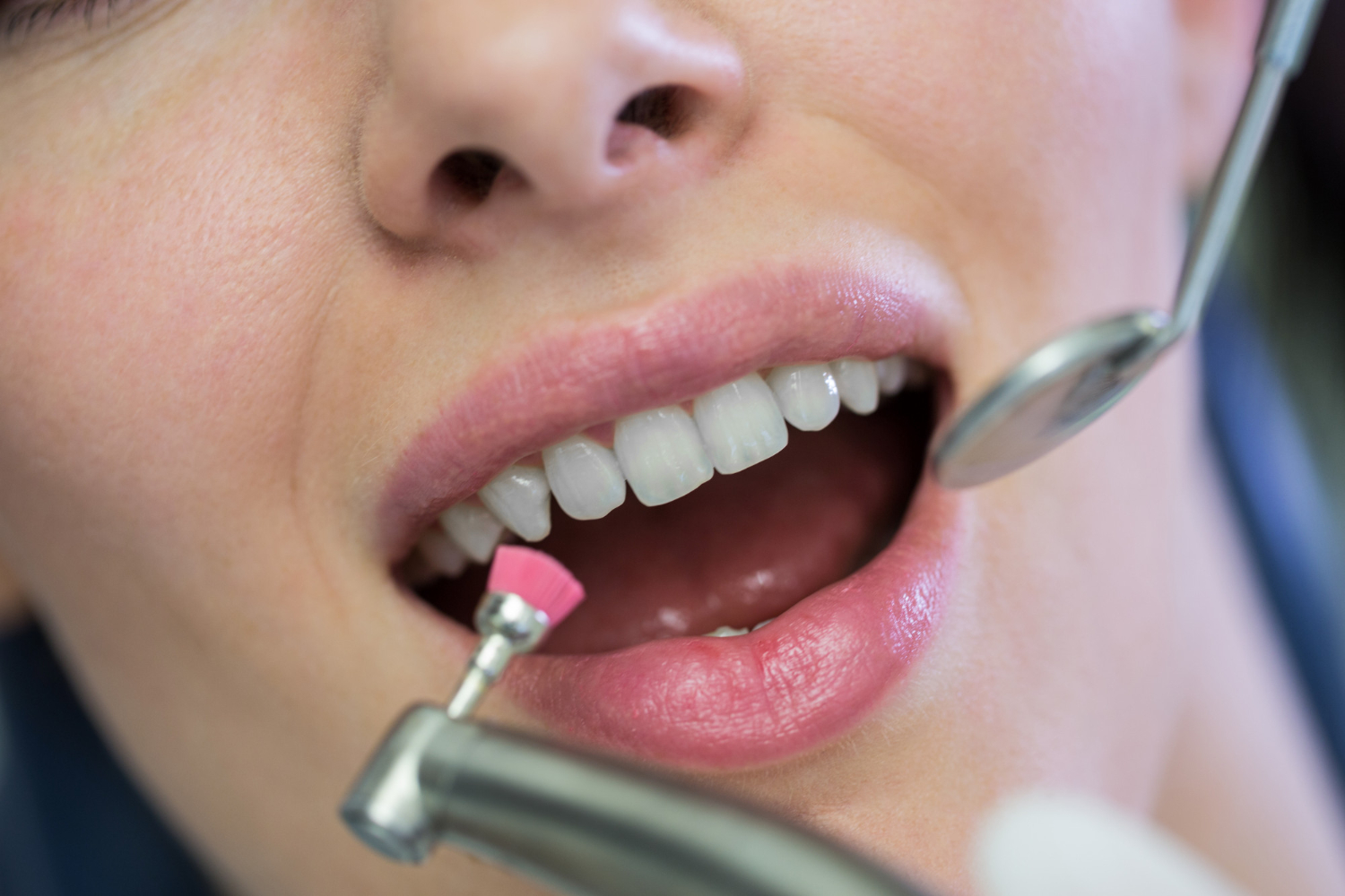 Dental Scaling