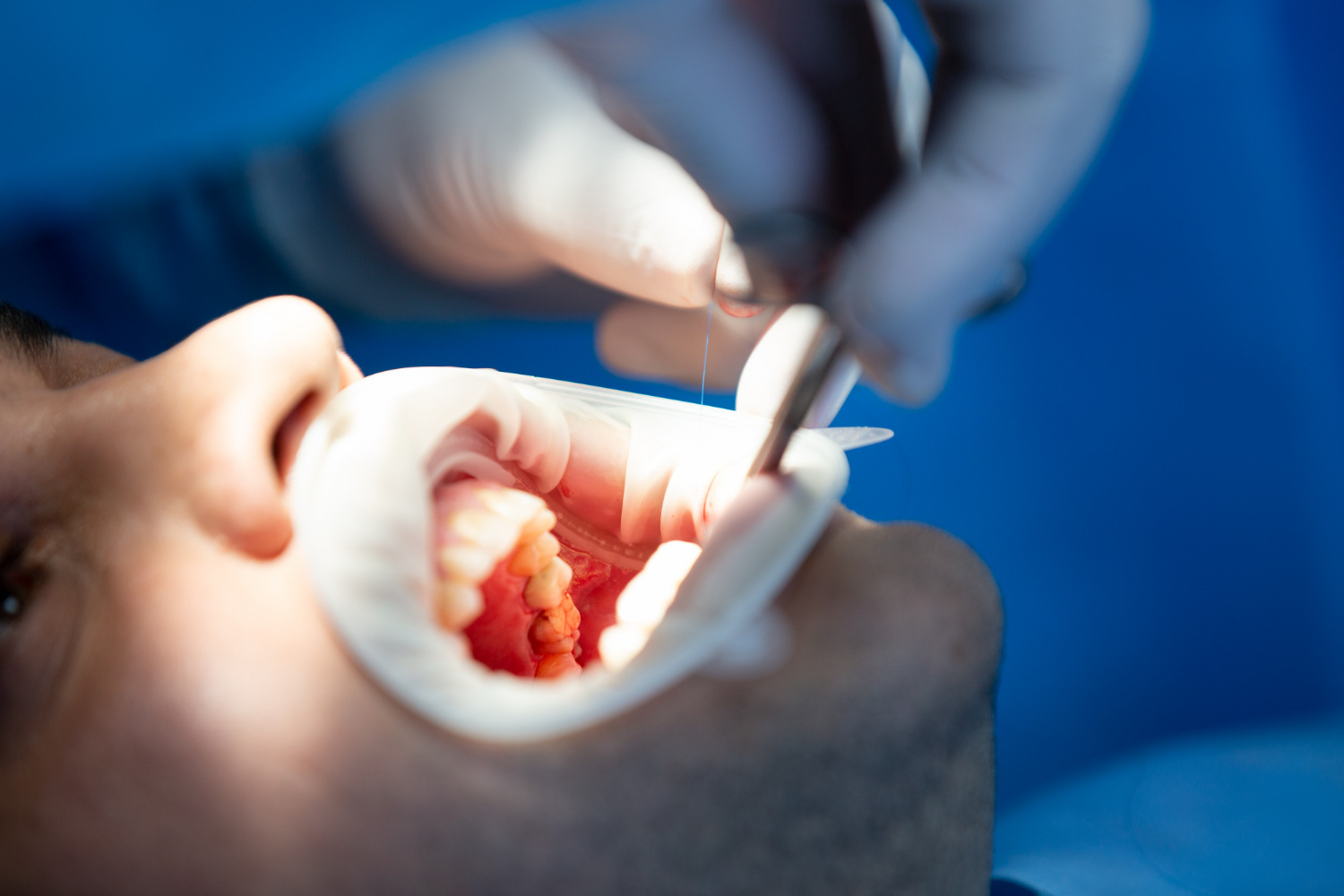 Dental Restorations